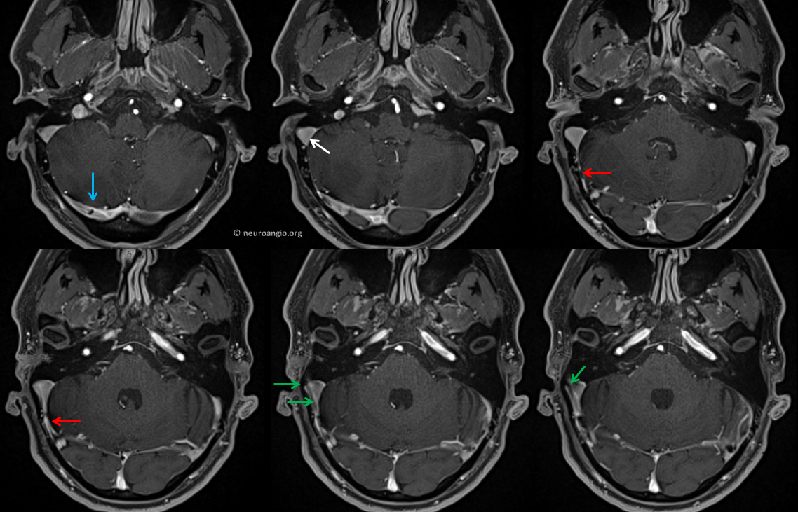 pulsatile-tinnitus-venous-sinus-stenosis-neuroangio